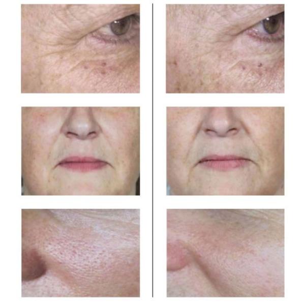 Filorga 135 Enchimento Mesoterapia Olhos Reverso Reparação da Pele Intensiva Enchido 135ha