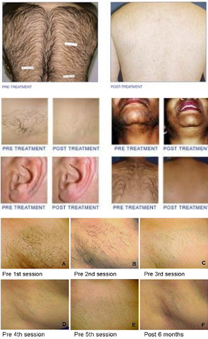 lastest Best result IPL laser hair scar removal Skin lighten machine with 3 handles