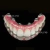 Implanted Dentures Manufacturer Customized Implant Teeth Bridge with Real Bite Sensation for Oral Restoration