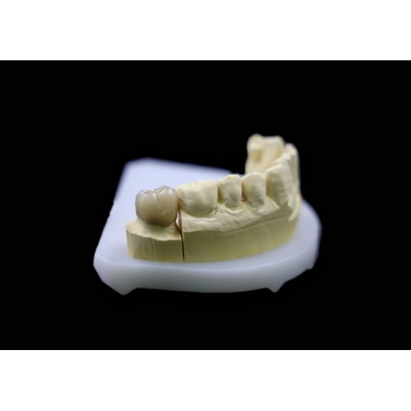 China Dental Lab Porcelain-Fused-to-Metal (PFM) Crowns