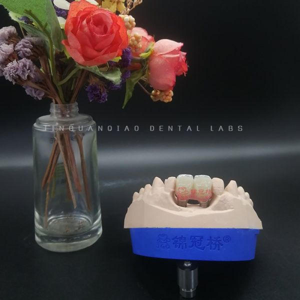 Dental Implant Screw Retained Crowns Titanium Bar Implant Supported Hybrid Denture
