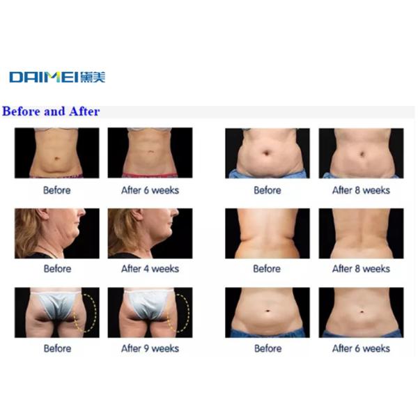 Popular Cryolipolysis Slimming Machine Fat Freezing Body Slimming Anti Cellulite Device