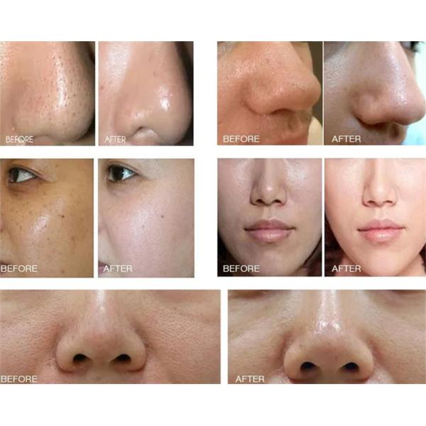 Diamond Microdermabrasion Machine Facial Spray portatif pour le centre de beauté