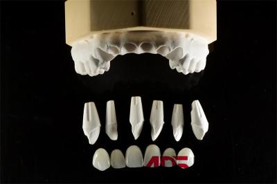 Dental Porcelain Feldspathic Veneers For Teeth Custom Shaped