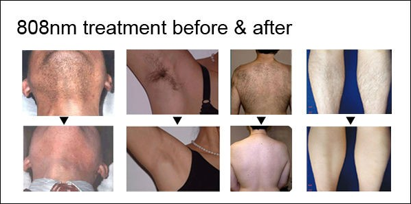 600W 1-10 Hz Alexandrite Laser Hair Removal Machines With 8