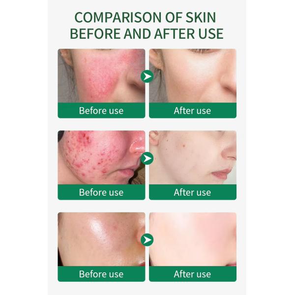 Reparación de Glicerina Hidratante Suero para el rostro Cuidado de la piel Blanqueamiento de los poros