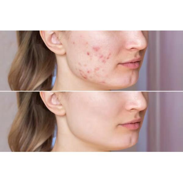 Lifting Ultrasound Introduction Lifting and Tightening Beauty Instrument