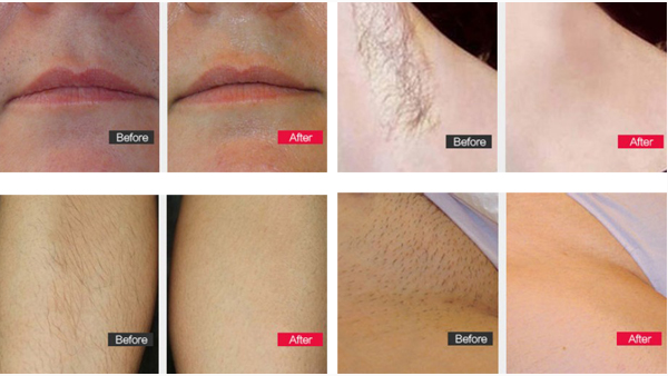 Dispositivo de depilación permanente para el rejuvenecimiento de la piel