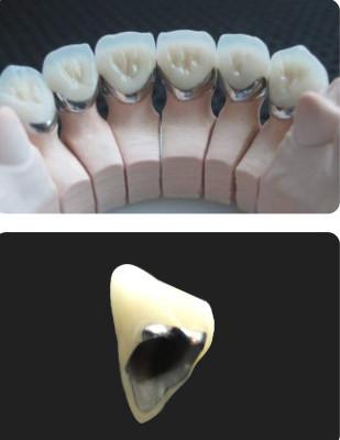 Porcelana fundida a metal PFM resistência ao desgaste dental da coroa para odontologia restaurativa