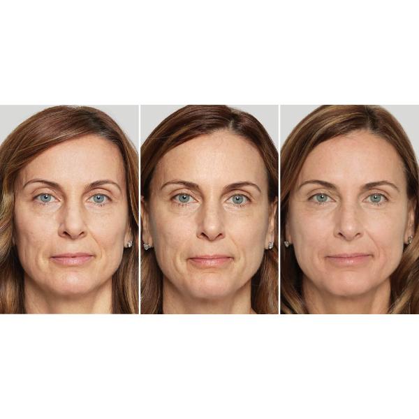 Медицинская поли- Л- молочная кислота для лица Dermal Filler Dermal fillers 1 флакон X 5 ml