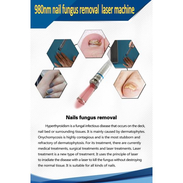 spider veins vascular vein removal nail fungus 980nm diode laser therapy machine for toe nail fungus treatment