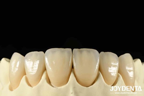 Bionic Development Leaves And Distinct Layers Of Zirconia All-Ceramic