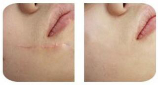 Medical Fractional Co2 Laser For Acne Scars Beauty Salon Equipment 10600nm Wavelength