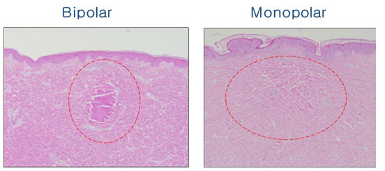 5mhz Touch High Quality Screen Thermage Skin Treatment Machine Nubway