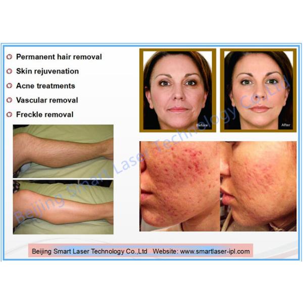 Portable SHR IPL Hair Removal Machine