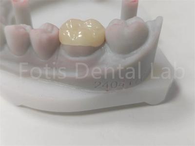 OEM Dental Inlay And Onlay Ceramic Restoration And Tooth-Colored Filling