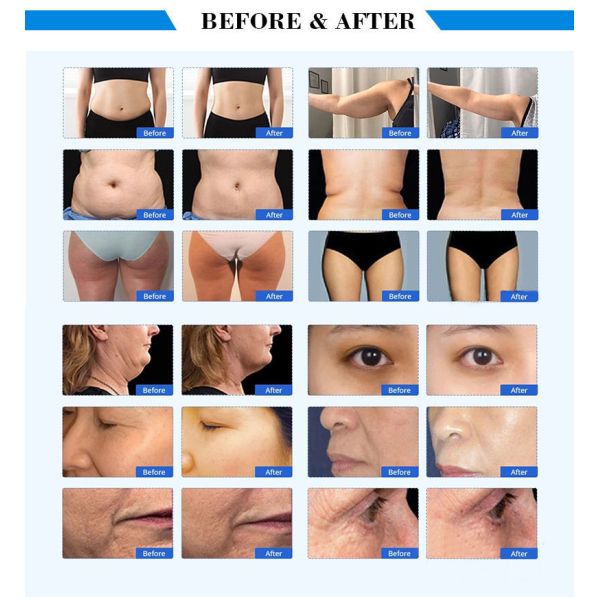 вакуум Lipolaser машины красоты кавитации 630nm 150W 40k RF ультразвуковой