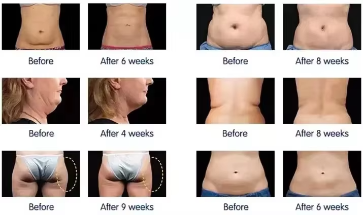 Non Invasive 360 Roller Body Contouring  RF Vacuum 40K Cavitation Velashaping Slimming Machine
