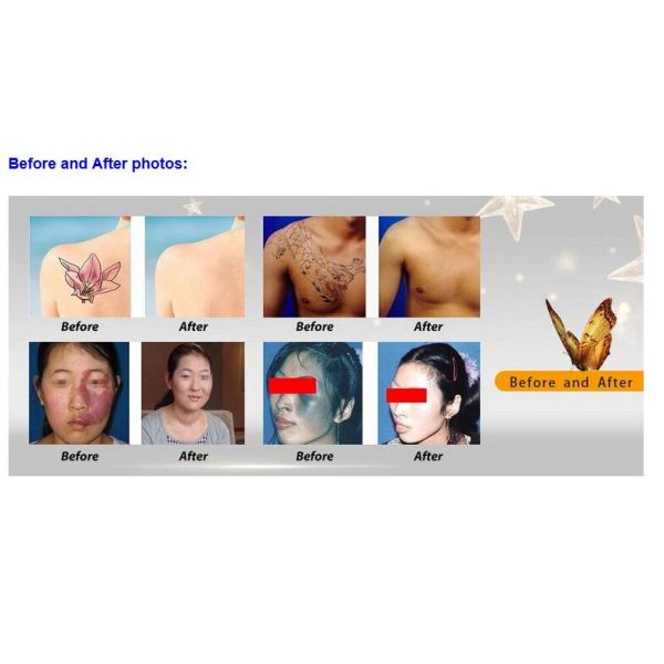 Professional Picosure Laser Machine , Q Switched Nd Yag Laser Tattoo Removal Equipment