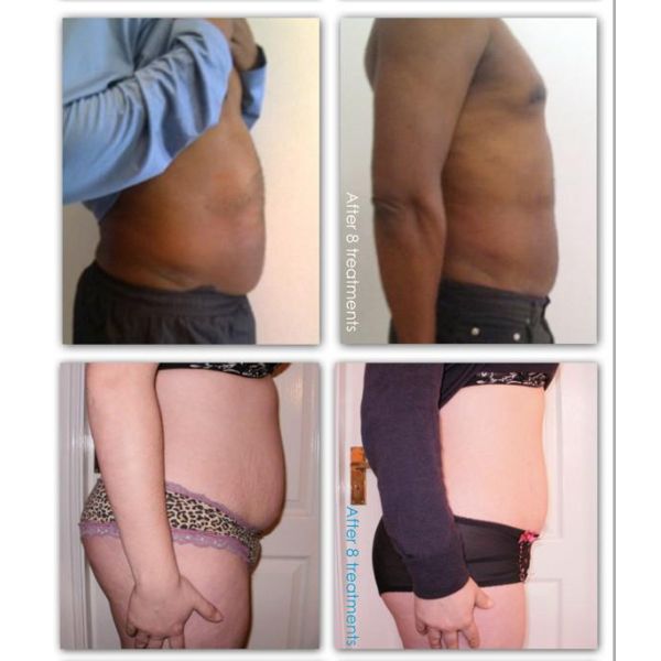 New design Lipo laser slimming