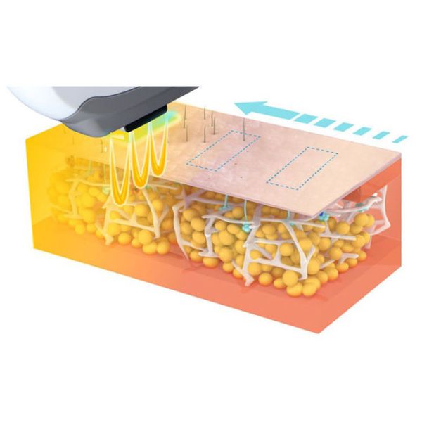 1hz Lasertell Super Hair Removal Machine 2 In 1 Painless