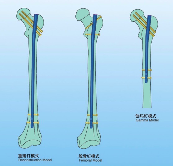 Протезная бедровая интрамедуллярная функция системы 340-420mm ногтя Multi