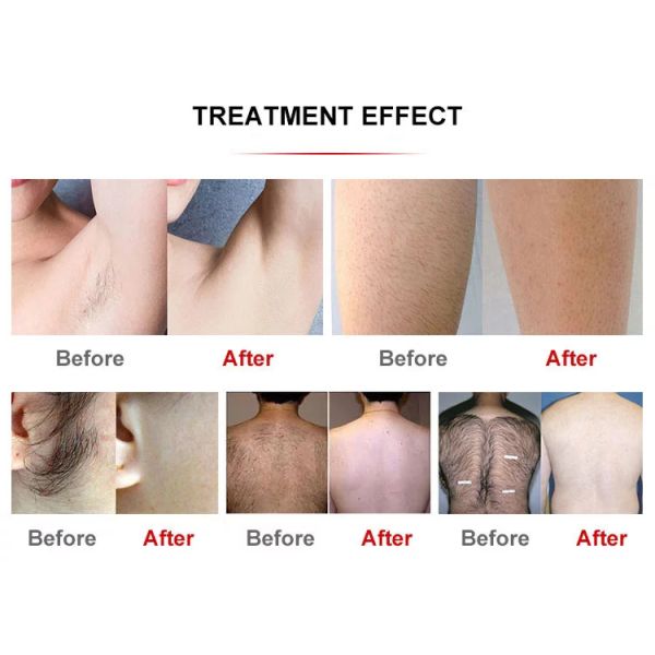 Máquina de depilación de fibra láser multifunción sin dolor 808nm