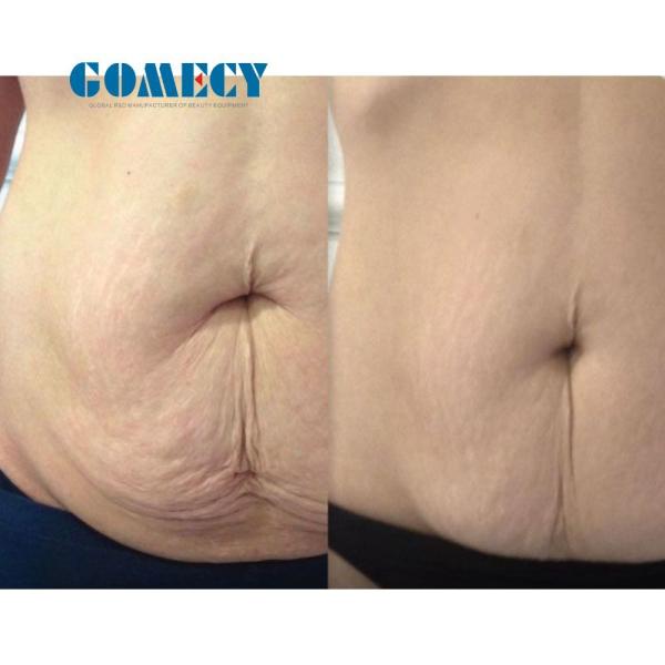 Super Quality Thermal RF Ultralift Titanium Equipment for Skin Firming Body Contouring and Post Pregnancy Restoration