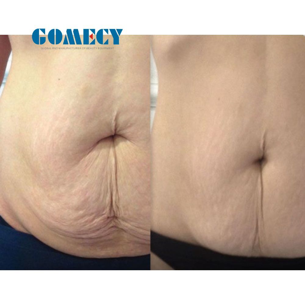 Super Quality Thermal RF Ultralift Titanium Equipment for Skin Firming Body Contouring and Post Pregnancy Restoration