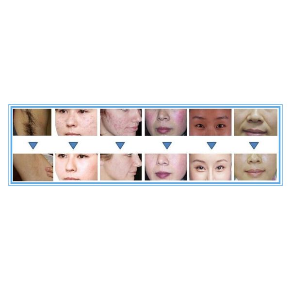 Newest SHR E Light IPL Hair Removal Ipl Beauty Machine Multifunction