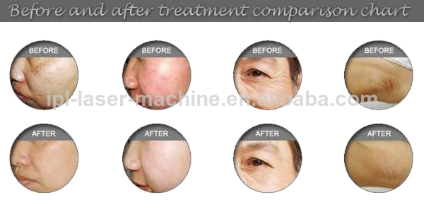 high frequency IPL laser hair removal Skin lighten acne wrinkle removal  machine
