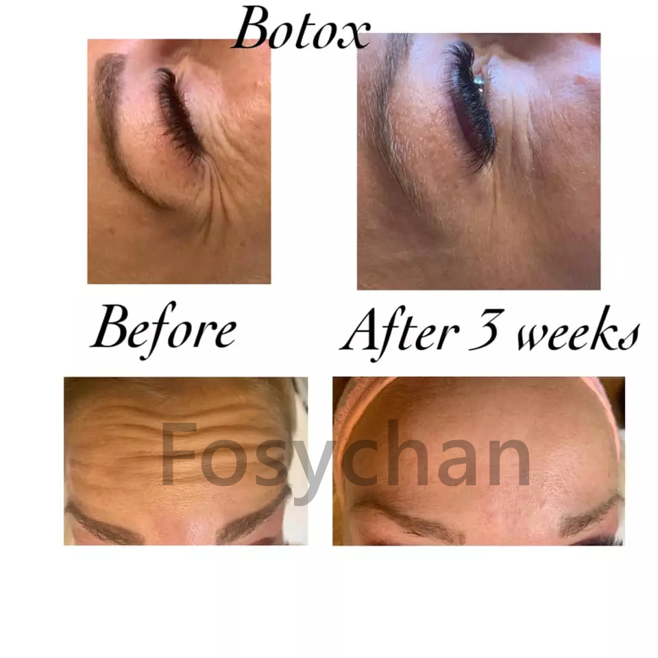 Впрыска Hyamely Botox блоков токсина 100 анти- морщинок Botulinum
