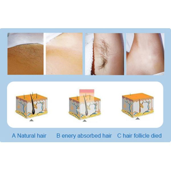 TUV Approved Women Laser Laser Depilation Machine Clinics Used Professional