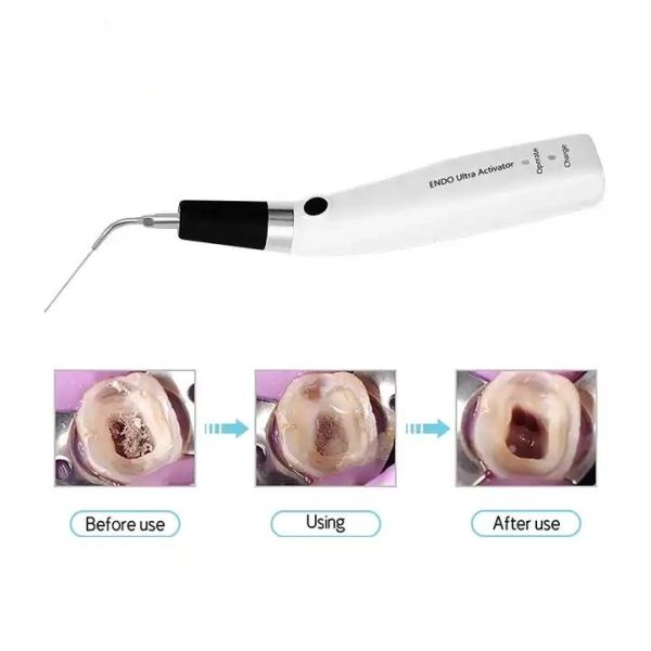 Dental Cordless Ultrasonic Activator Equipment  Sonic Irrigator Endo Activator