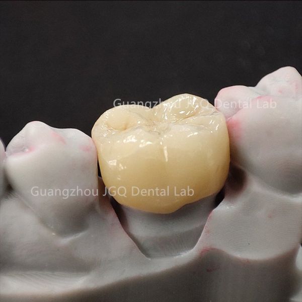 High Fracture Resistant Zirconia Crown Bridge CNC For Bruxism Heavy Occlusion