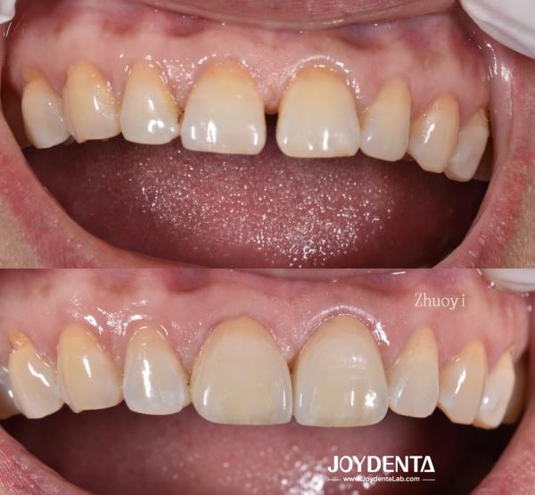 0.5mm épaisseur faisceaux dentaires Perméabilité parfaite Faisceaux de porcelaine pour les dents creuses