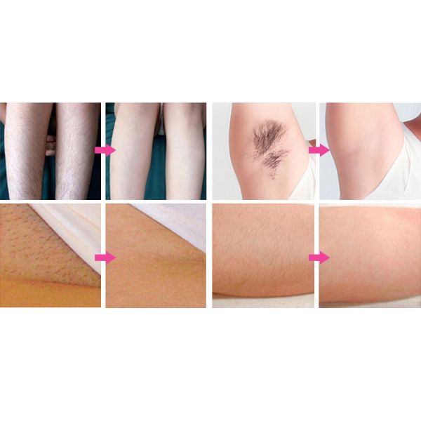 High Quality 7 Languages 5 Heads Diode-Lasersings Hair Removal Machine with Nose Hair Head