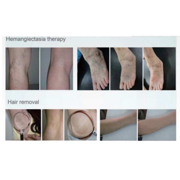 ИМП ульс лазера 1064нм Нд Яг черной машины удаления волос лазера диода кожи безболезненный длинный