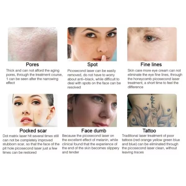 Picosecond 532nm 1064nm 1320nm Remove Tattoo ND Yag Laser Machine