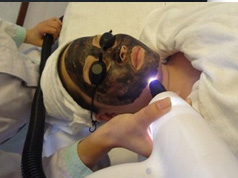 Portable color free Q Switch Nd Yag Laser Tattoo,Spot  Removal machine