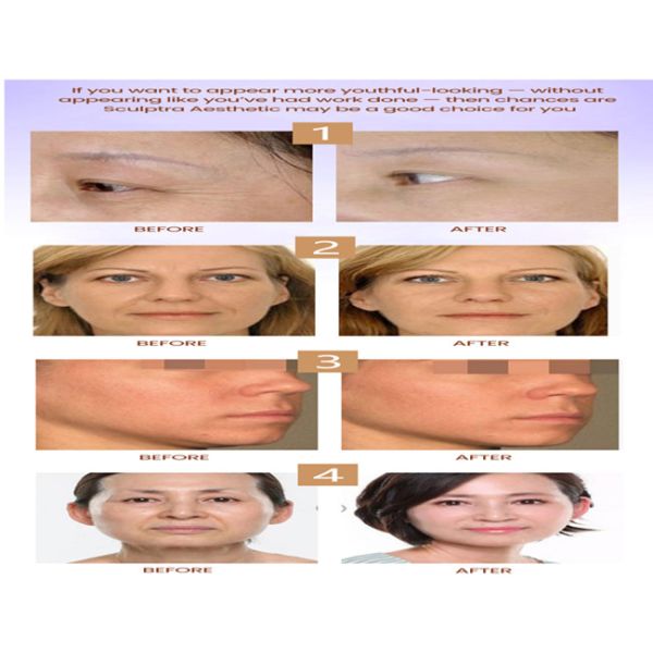 ПЛЛА поли- l- молочная кислота 1 флакон x5 мл ПЛЛА пломба антивозрастная пластическая хирургия лица