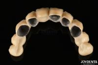 PFM Ceramic Fused To Metal Crown High Biocompatible and Corrosion Resistant