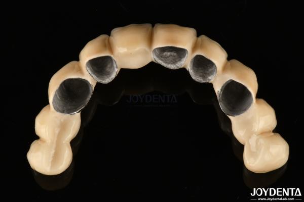 PFM Ceramic Fused To Metal Crown High Biocompatible and Corrosion Resistant