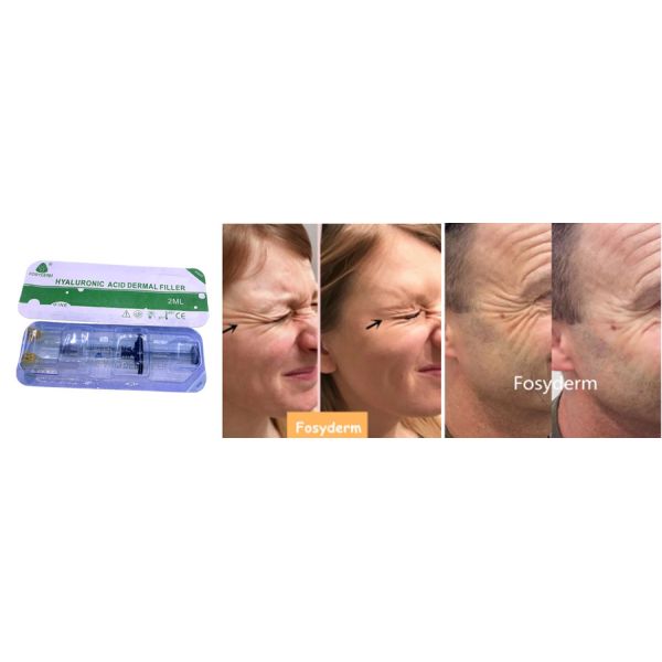 Fosyderm Hyaluronic Acid Facial Filler Dermal filler injection