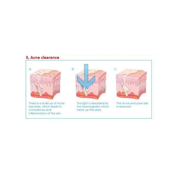 Laser for tattoo Removal Body Slimming Ipl Beauty Machine For Hair Removal