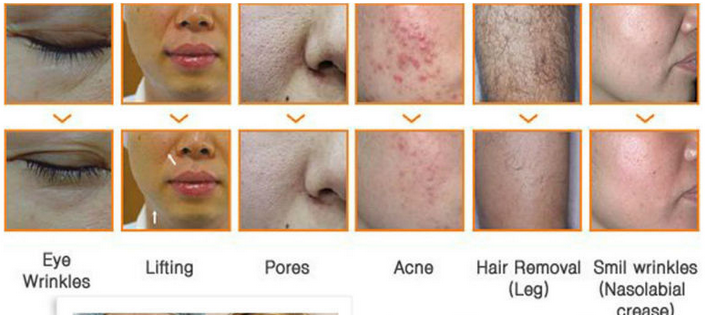 Home Permanent SHR Hair Removal / Body Slimming Cellulite Reduction Skin Tightening