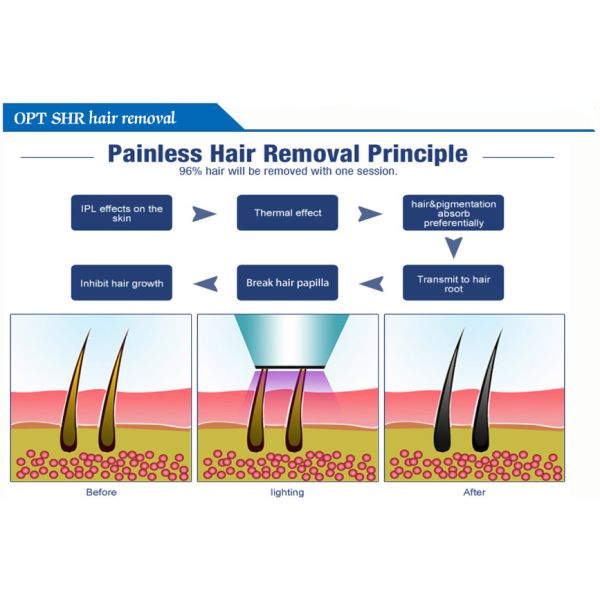 OPT SHR IPL Hair Removal Machine Permanent Painless Hair Remover
