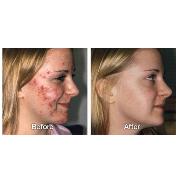 Skin Tighten Face Lifting 6 In 1 Vacuum Microdermabrasion Machine