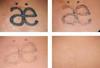 Best High Energy 1500mj 1064nm 532nm Painless Permanent Skin Age Spot Freckle Removal Machine Yag Laser Remove Tattoo