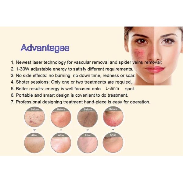 Машина удаления вен паука 20HZ 50W экран касания 8,4 дюймов